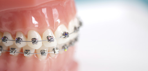Top Benefits Of Orthodontic Treatment - West Cobb Dentistry
