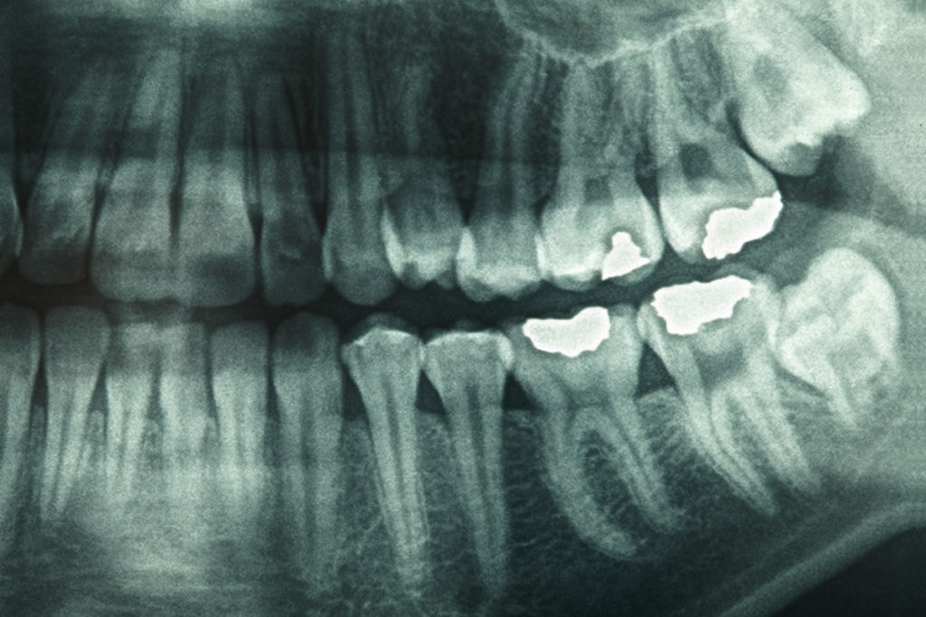 How Safe Are Dental XRays? What's involved and why they're performed.