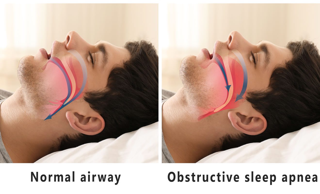 Sleep Apnea How Your Dentist Can Help From 123Dentist