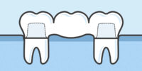 What are Dental Bridges and How Do They Work?