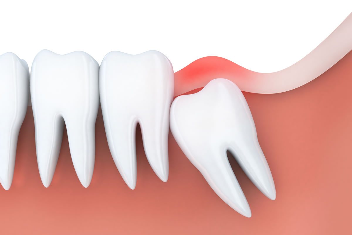 The Wisdom Tooth Removal Process In 2018 From 123Dentist